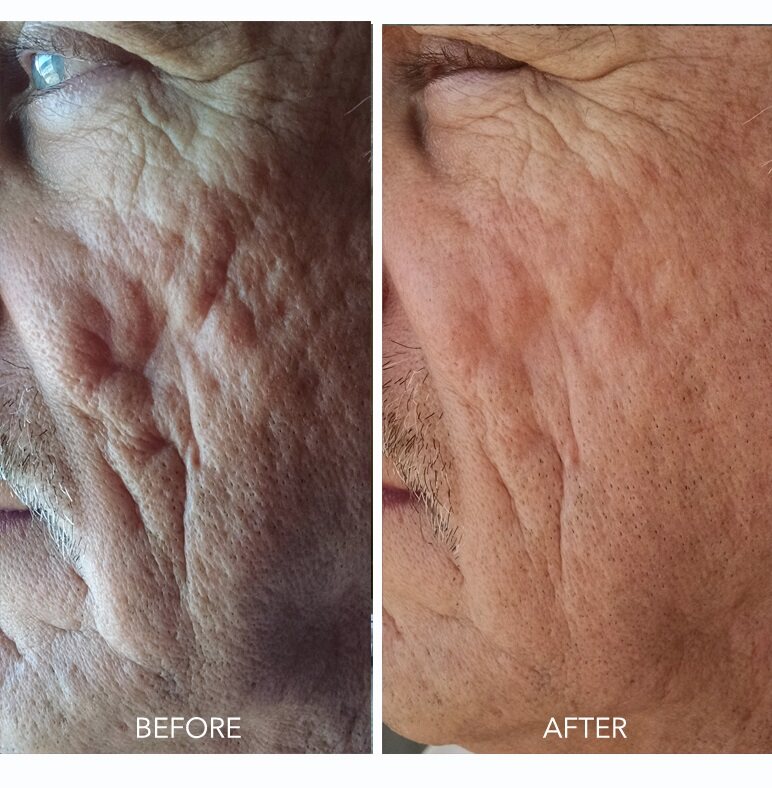 microneedling