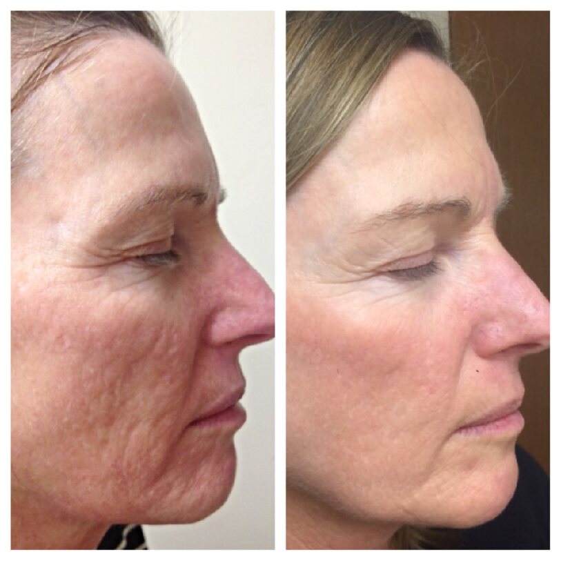 microneedling