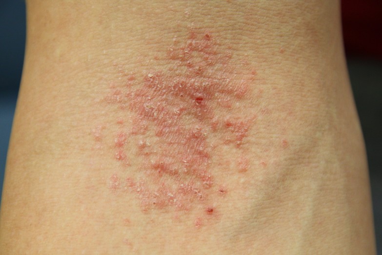 eczema